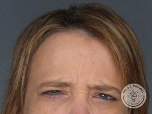 blonde woman top half of face frowning before botox in nashville at dr j j wendel plastic surgery