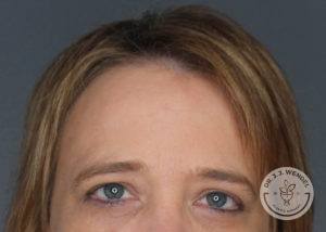 blonde woman top half of face before botox in nashville at dr j j wendel plastic surgery