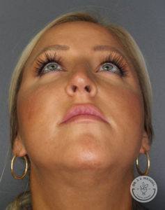 woman's face tipped slightly upwards before rhinoplasty in Nashville at Dr. J. J. Wendel Plastic Surgery
