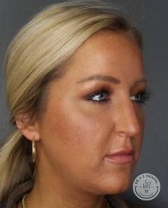 woman's face turned slightly left before rhinoplasty in Nashville at Dr. J. J. Wendel Plastic Surgery