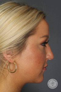 woman's left side of face profile before rhinoplasty in Nashville at Dr. J. J. Wendel Plastic Surgery