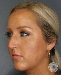 woman's face turned slightly right before rhinoplasty in Nashville at Dr. J. J. Wendel Plastic Surgery