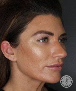 woman's face turned slightly left before rhinoplasty at Dr. J. J. Wendel Plastic Surgery in Nashville