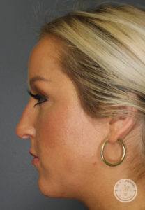 woman's right side of face profile before rhinoplasty in Nashville at Dr. J. J. Wendel Plastic Surgery