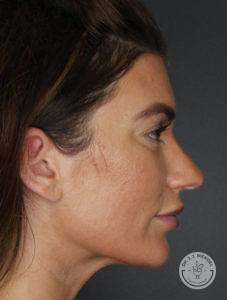 woman's left side of face profile before rhinoplasty at Dr. J. J. Wendel Plastic Surgery in Nashville