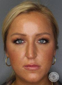 woman's face before rhinoplasty in Nashville at Dr. J. J. Wendel Plastic Surgery
