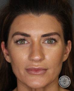 woman's face before rhinoplasty at Dr. J. J. Wendel Plastic Surgery in Nashville