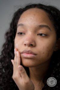 african american woman with acne touching her face