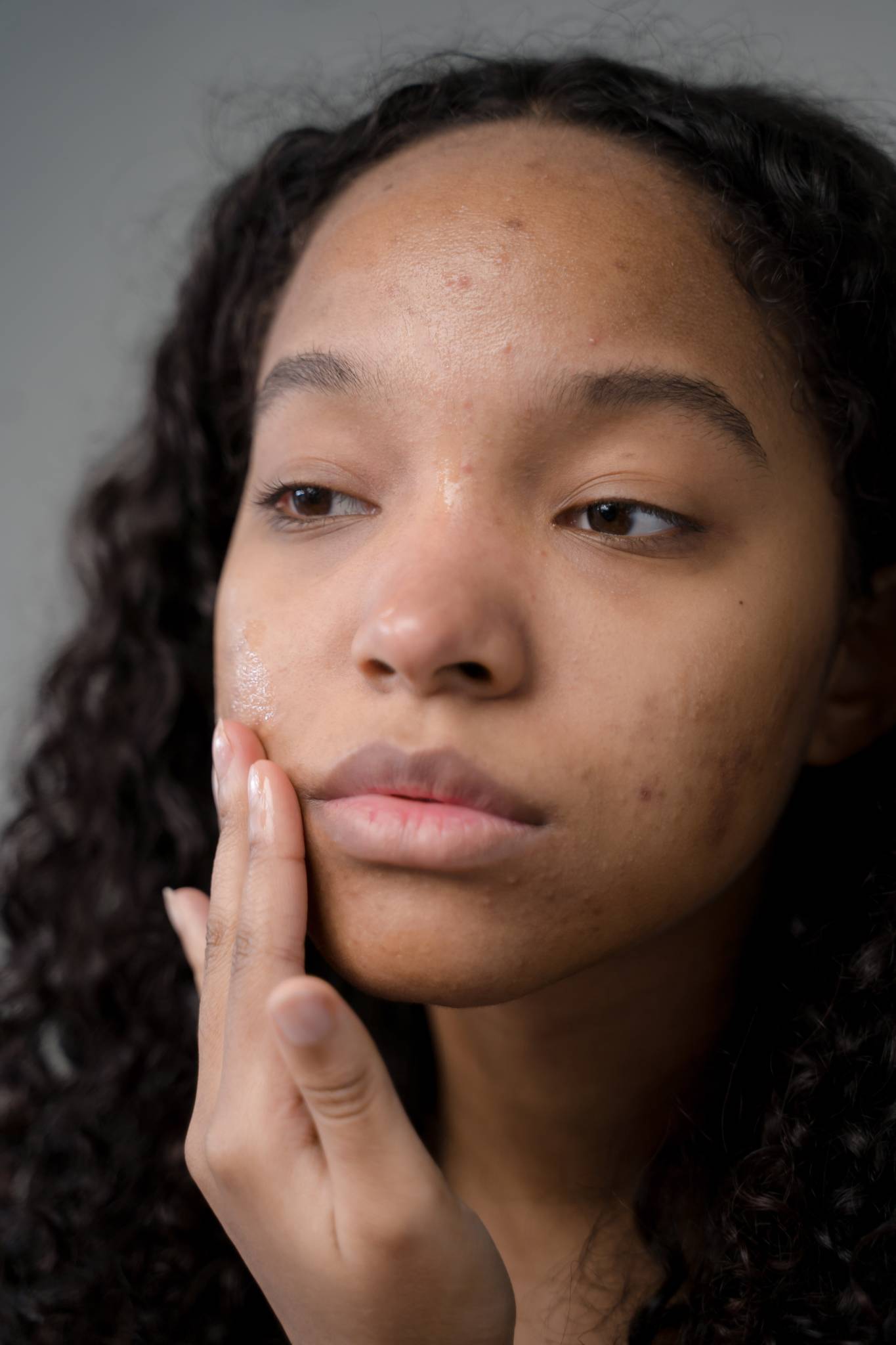 african american woman with acne touching her face