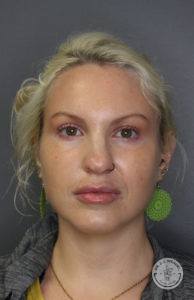 blonde woman headshot after dermal fillers