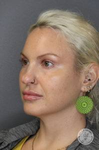 blonde woman with green earrings head slightly turned to right after dermal fillers