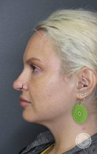 blonde woman with green earrings side of face after dermal fillers