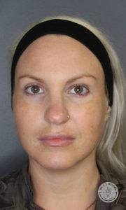 blonde woman headshot before dermal fillers