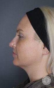 blonde woman side headshot before dermal fillers