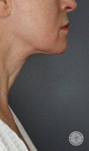 left side view of jawline of older woman after morpheus8 treatment in nashville