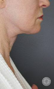 left side view of jawline of older woman before morpheus8 treatment in nashville