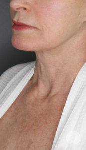 older woman turned slightly right jawline view before morpheus8 treatment in nashville