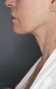 right side view of jawline of older woman before morpheus8 treatment in nashville