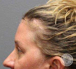 Left side view of woman's hairline and temple area after brow lift surgery