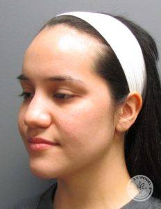 Left oblique view of woman's cheek and jawline after buccal fat pad removal surgery