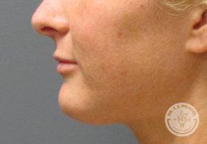 Left profile view of woman's lips after lip implants