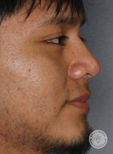 side profile of man facing right after liquid nose job