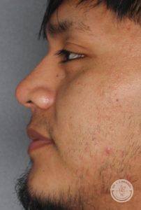 side profile of man facing left after liquid nose job