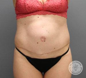 front view of female torso after tummy tuck at Dr. J. J. Wendel Plastic Surgery in Nashville, Tennessee