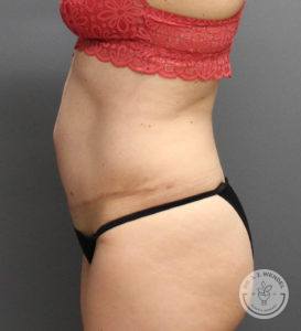 side view of female torso facing left after tummy tuck at Dr. J. J. Wendel Plastic Surgery in Nashville, Tennessee