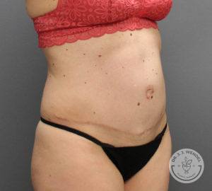 angled front view of female torso facing right after tummy tuck at Dr. J. J. Wendel Plastic Surgery in Nashville, Tennessee