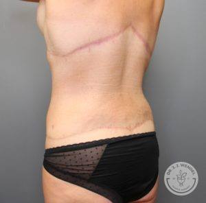 angled back view of female torso facing left after tummy tuck