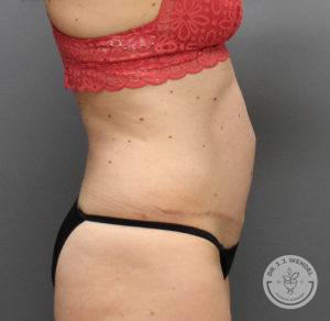 profile of female torso after tummy tuck facing right at Dr. J. J. Wendel Plastic Surgery in Nashville, Tennessee