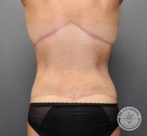 back view of female torso after tummy tuck