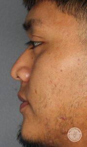 side profile of man before liquid nose job
