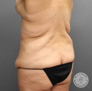 angled back view of female torso facing left before tummy tuck