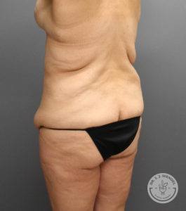 angled back view of female torso facing left before tummy tuck