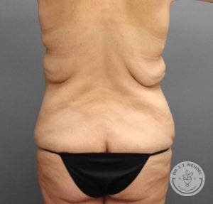 back view of female torso before tummy tuck