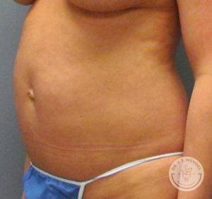 angled front view of close up on woman's body before tummy tuck facing left