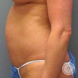 close up on side view of woman's body before tummy tuck facing left