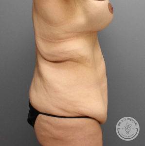 side view of female torso facing right before tummy tuck