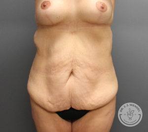front view of female torso before tummy tuck