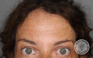 close up of upper half of woman's face with eyes wide open after botox