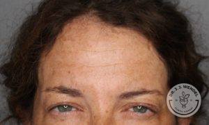 close up on woman's upper half of face with eyes squinted after botox