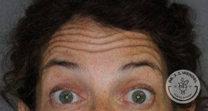 close up of woman's eyes and forehead with eyebrows raised before botox