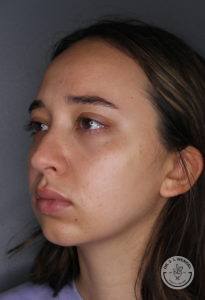 close up of young woman's face facing left before Juvederm Voluma chin filler