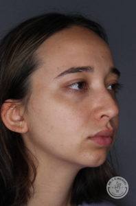 angled view of young woman's face facing right before Juvederm Voluma Chin filler