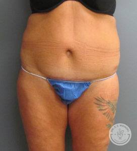 front view of woman's torso after liposuction surgery