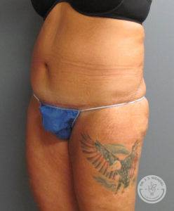 angled left view of woman's stomach after liposuction
