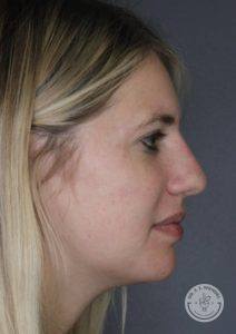 right side profile view of female face after liquid rhinoplasty