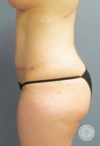 side profile of female torso after tummy tuck procedure